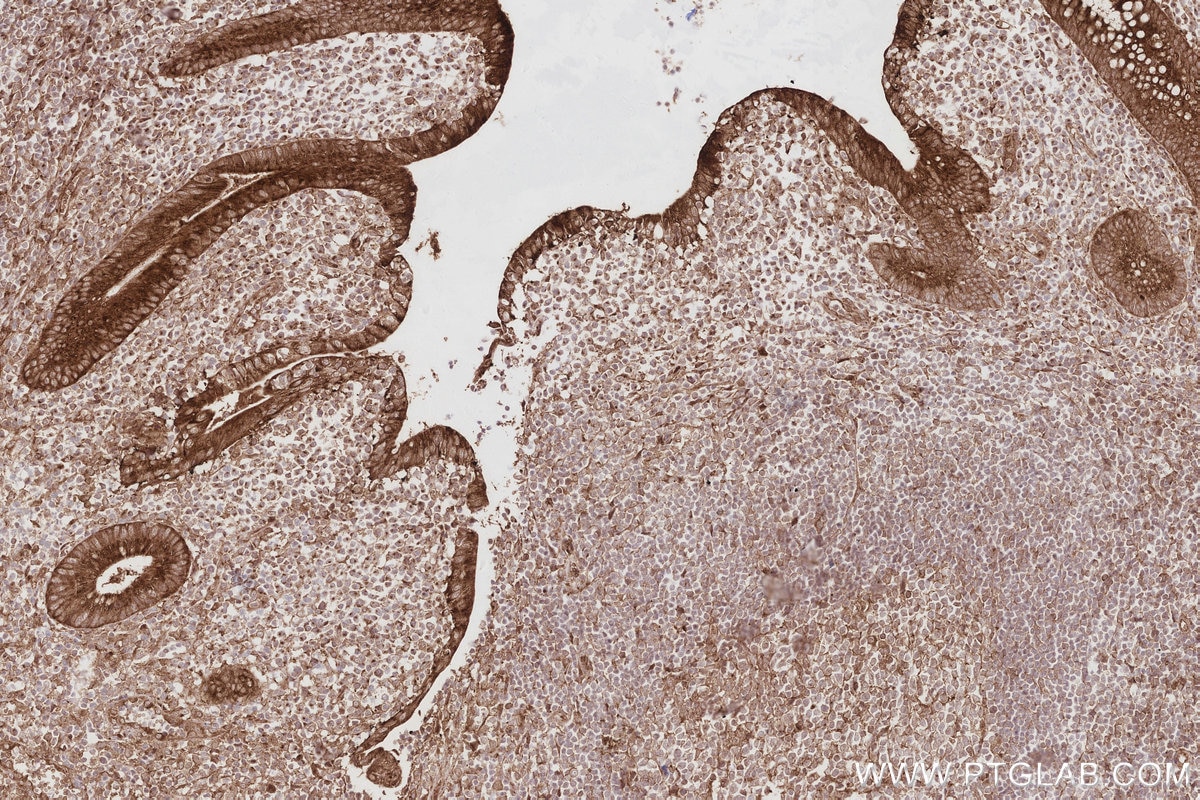 IHC staining of human appendicitis using 83656-3-RR Immunohistochemistry (IHC) staining of human appendicitis tissue using TMEM59 Recombinant monoclonal antibody (83656-3-RR)