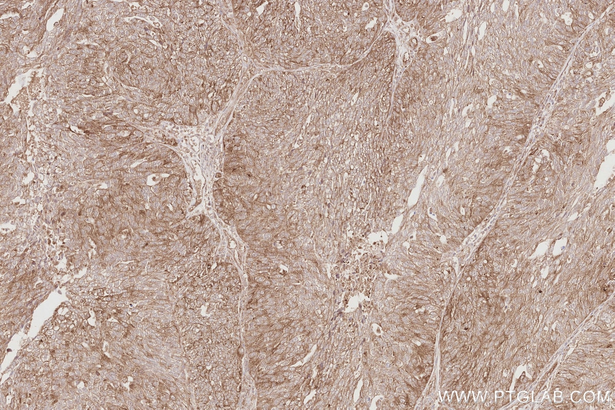 IHC staining of human ovary cancer using 83656-3-RR Immunohistochemistry (IHC) staining of human ovary cancer tissue using TMEM59 Recombinant monoclonal antibody (83656-3-RR)