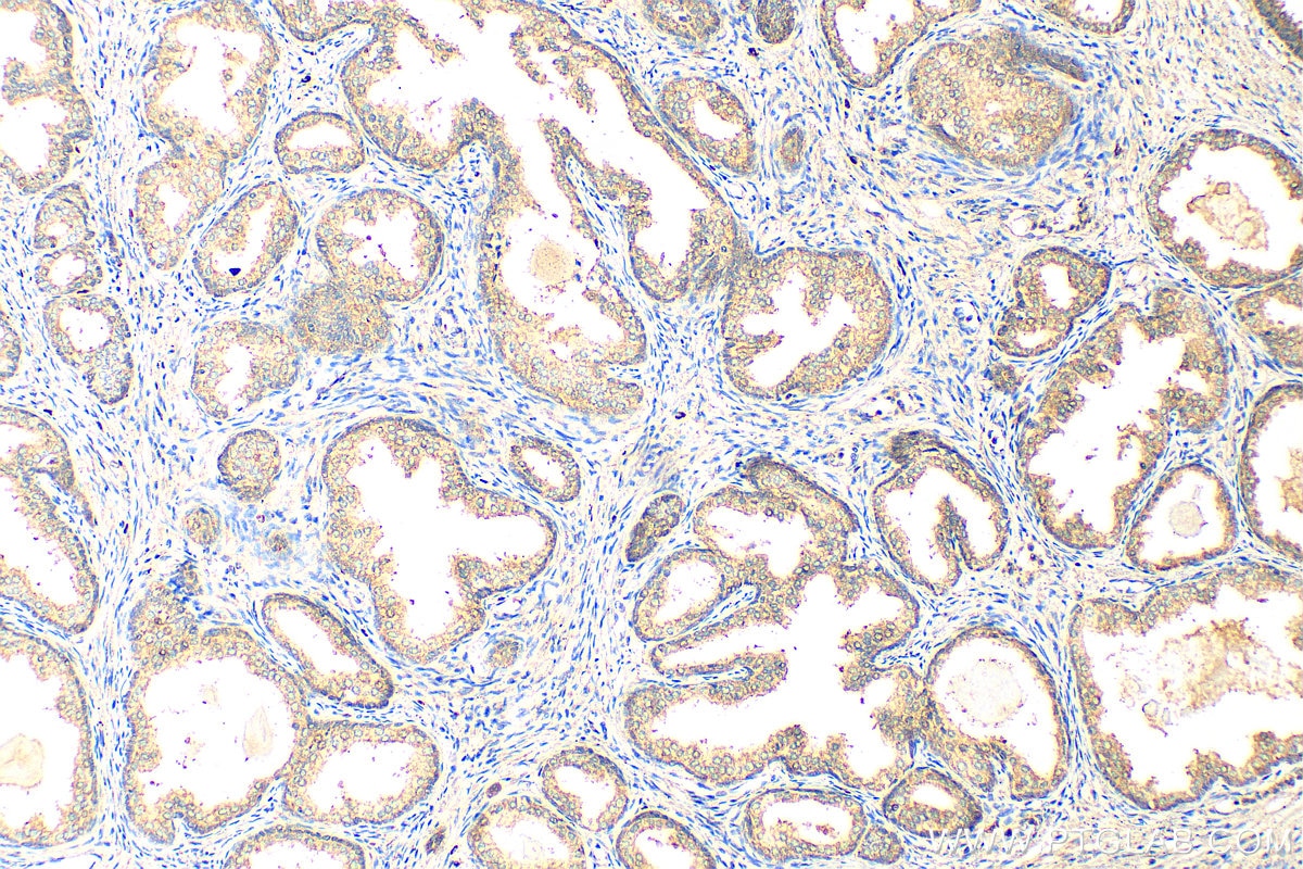 Immunohistochemistry (IHC) staining of human prostate cancer tissue using TMEM64 Polyclonal antibody (21274-1-AP)