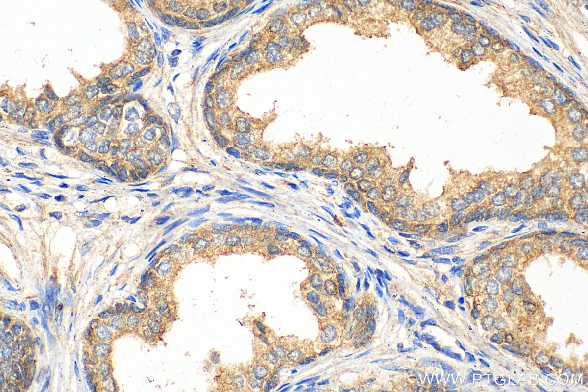 Immunohistochemistry (IHC) staining of human prostate cancer tissue using TMEM64 Polyclonal antibody (21274-1-AP)