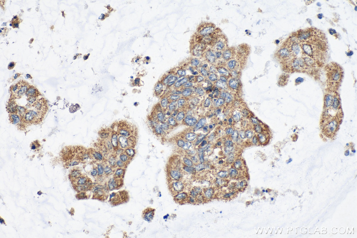 Immunohistochemistry (IHC) staining of human colon cancer tissue using TMEM65 Polyclonal antibody (21913-1-AP)
