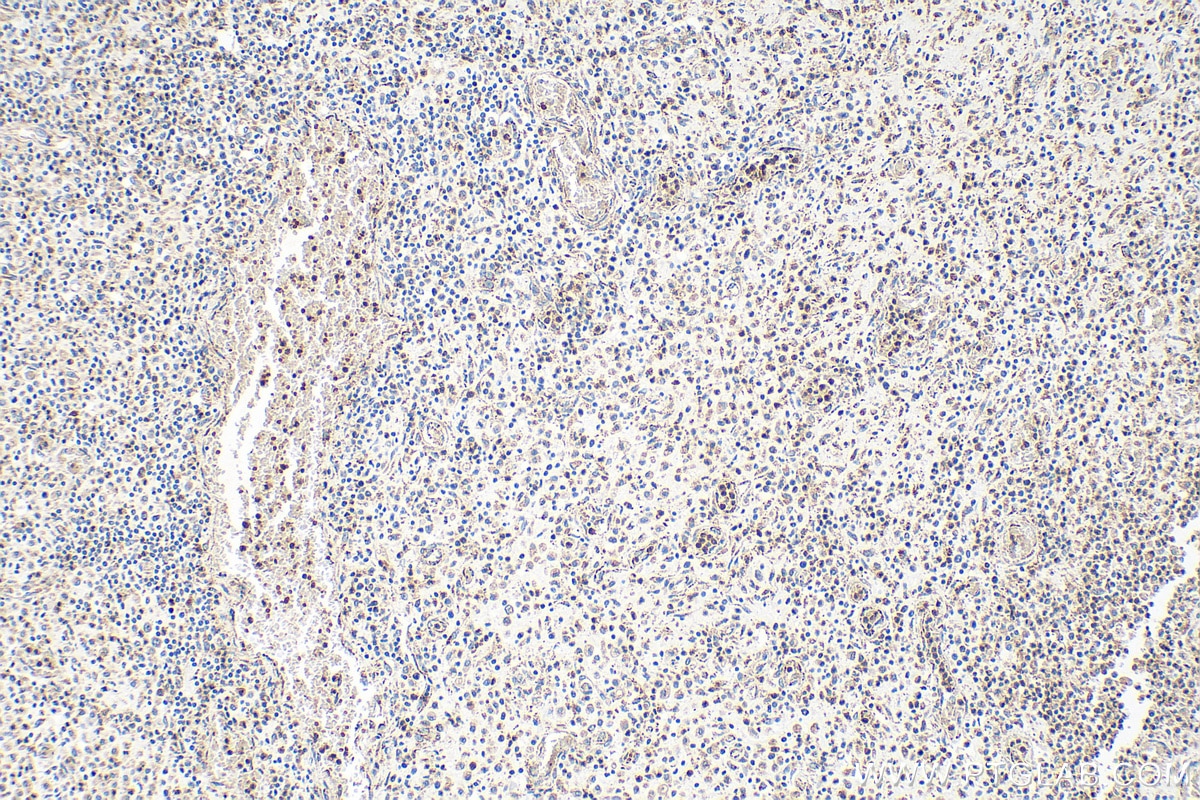 Immunohistochemistry (IHC) staining of human colon cancer tissue using TMEM65 Polyclonal antibody (21913-1-AP)