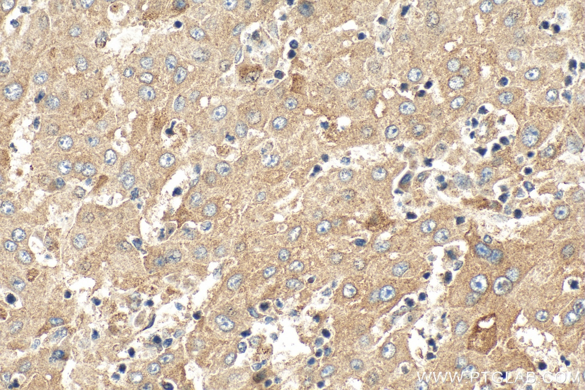 Immunohistochemistry (IHC) staining of human liver cancer tissue using TMEM65 Polyclonal antibody (21913-1-AP)