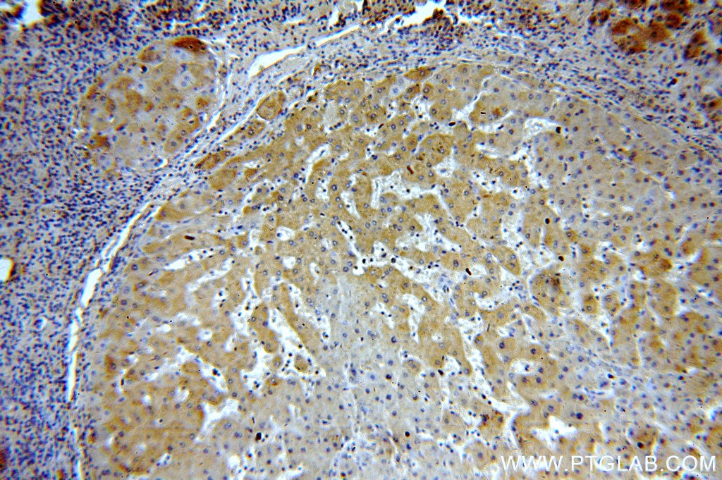 Immunohistochemistry (IHC) staining of human hepatocirrhosis tissue using MKS3 Polyclonal antibody (13975-1-AP)