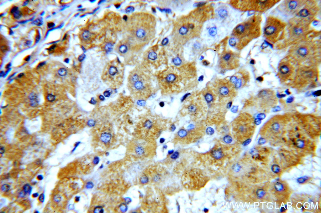 IHC staining of human hepatocirrhosis using 13975-1-AP