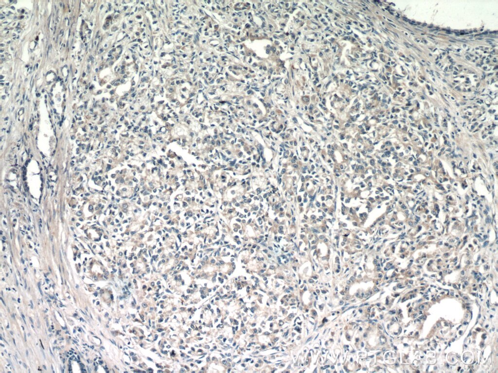 Immunohistochemistry (IHC) staining of human prostate cancer tissue using TMEM71 Polyclonal antibody (16722-1-AP)