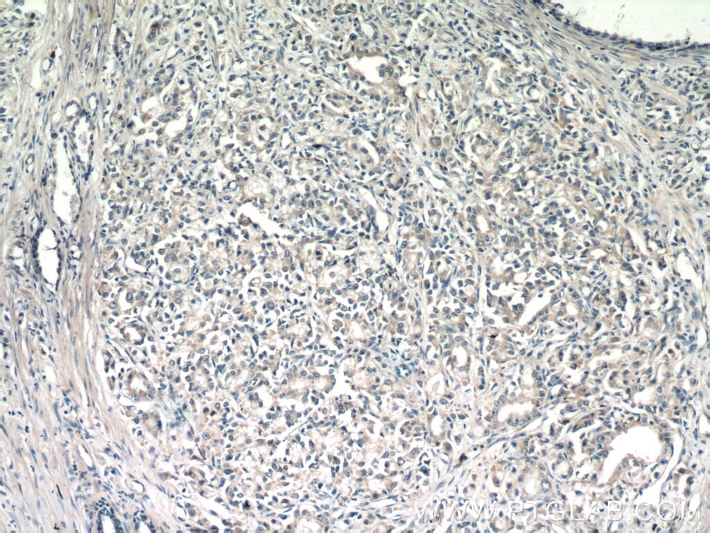 IHC staining of human prostate cancer using 16722-1-AP