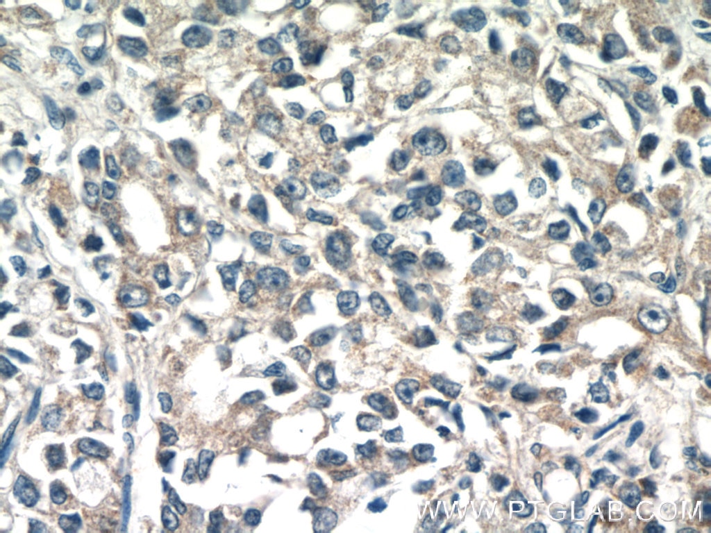IHC staining of human prostate cancer using 16722-1-AP
