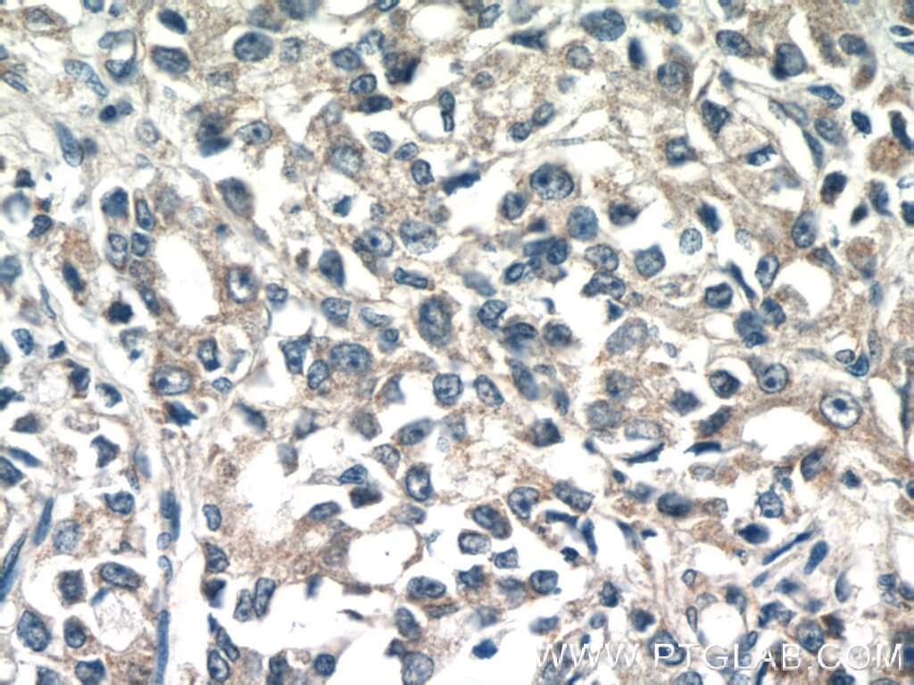 Immunohistochemistry (IHC) staining of human prostate cancer tissue using TMEM71 Polyclonal antibody (16722-1-AP)