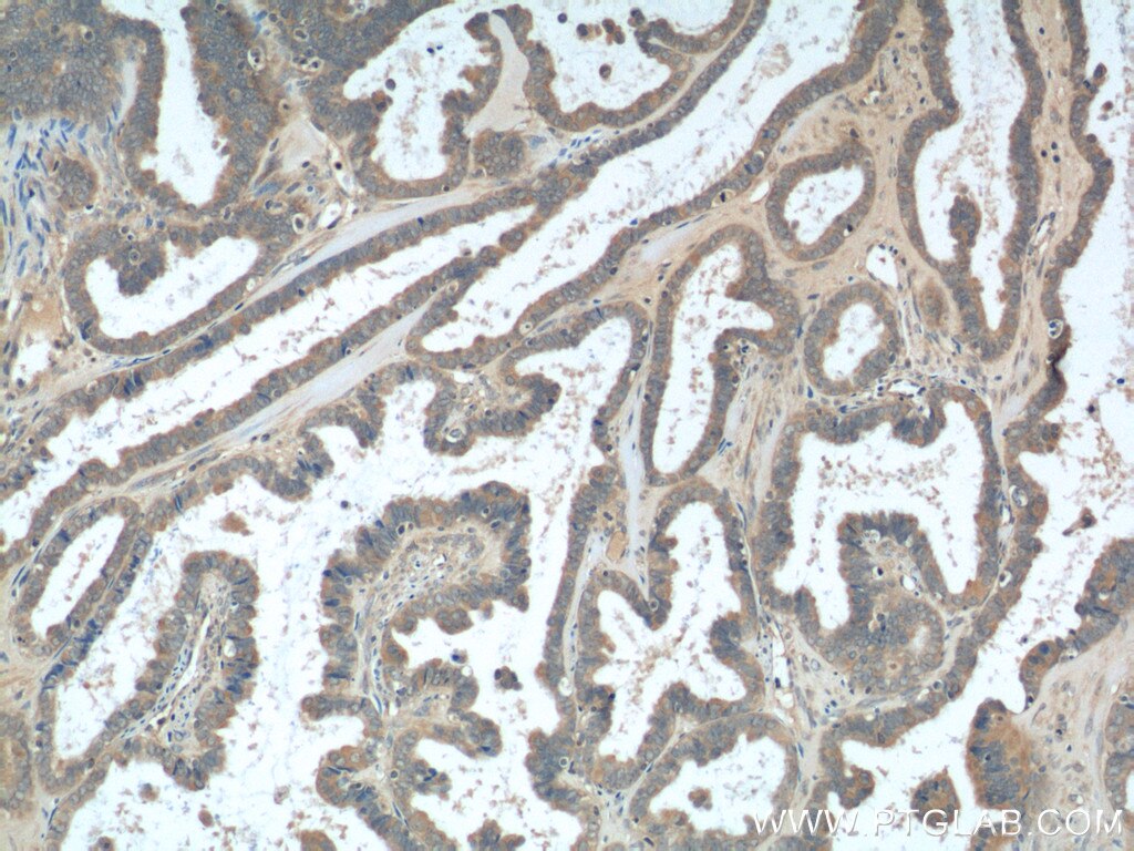 Immunohistochemistry (IHC) staining of human ovary tumor tissue using TMEM77 Polyclonal antibody (23182-1-AP)