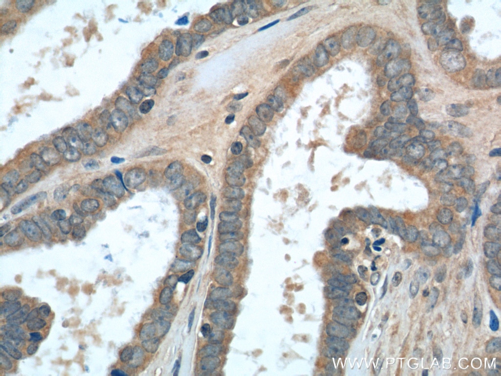 IHC staining of human ovary tumor using 23182-1-AP