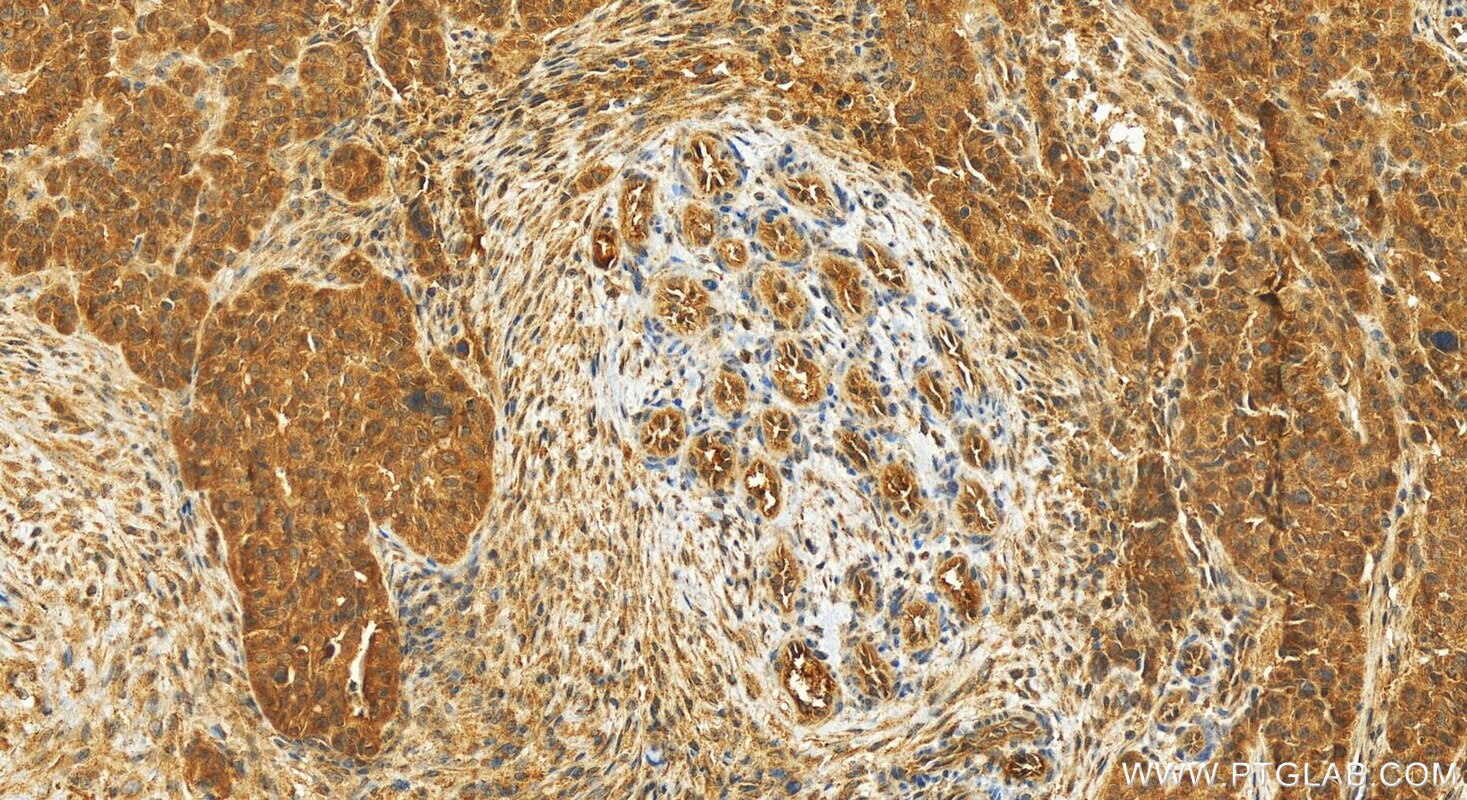 Immunohistochemical analysis of paraffin-embedded human ovarian cancer slide using 23182-1-AP (TMEM77 antibody) at dilution of 1:200 (under 20x lens). Heat mediated antigen retrieval with Tris-EDTA buffer (pH 9.0). Immunohistochemistry (IHC) staining of human ovarian cancer using TMEM77 Polyclonal antibody (23182-1-AP)