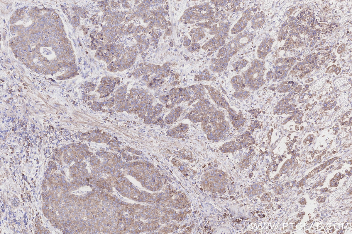 Immunohistochemistry (IHC) staining of human stomach cancer tissue using TMEM85 Polyclonal antibody (27708-1-AP)