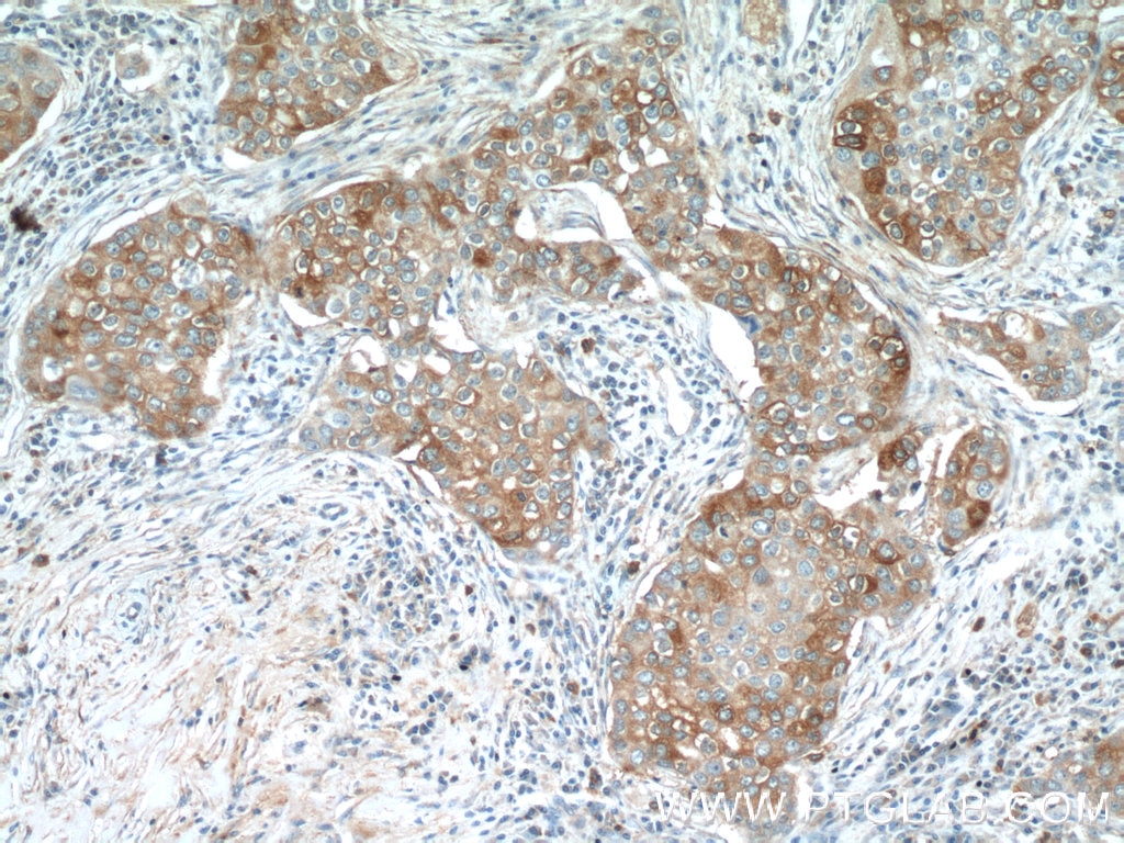 Immunohistochemistry (IHC) staining of human breast cancer tissue using TMEM87A Polyclonal antibody (25091-1-AP)