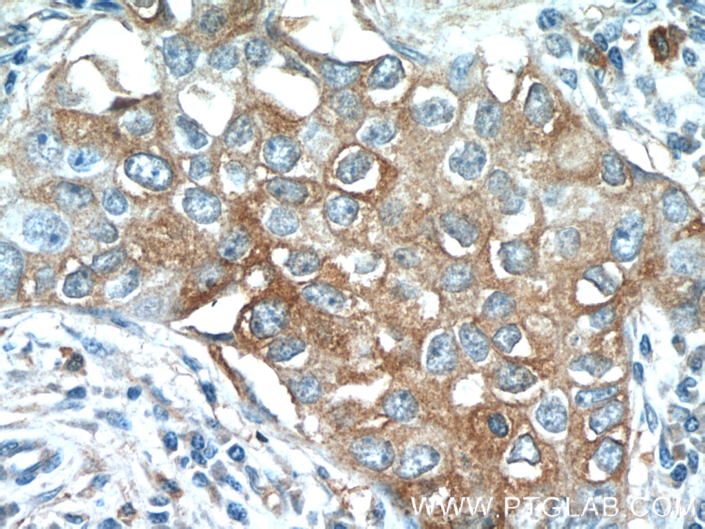Immunohistochemistry (IHC) staining of human breast cancer tissue using TMEM87A Polyclonal antibody (25091-1-AP)