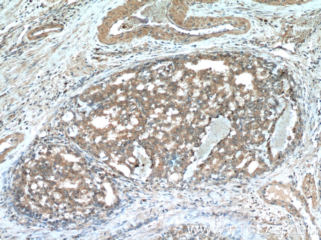 Immunohistochemistry (IHC) staining of human prostate cancer tissue using TMEM87A Polyclonal antibody (25091-1-AP)