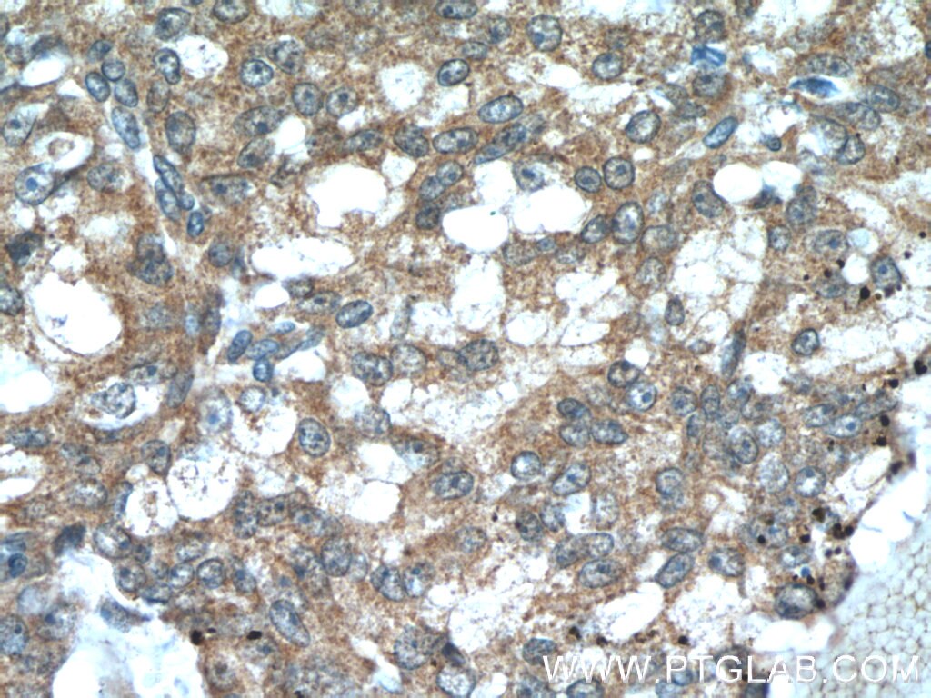 Immunohistochemistry (IHC) staining of human prostate cancer tissue using TMEM87A Polyclonal antibody (25091-1-AP)