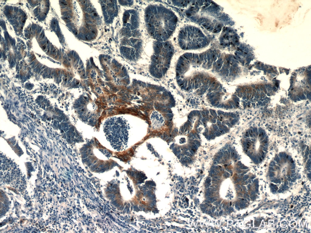 IHC staining of human colon cancer using 24331-1-AP