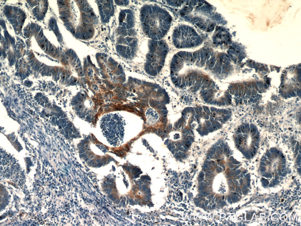 Immunohistochemistry (IHC) staining of human colon cancer tissue using TMEM9B Polyclonal antibody (24331-1-AP)