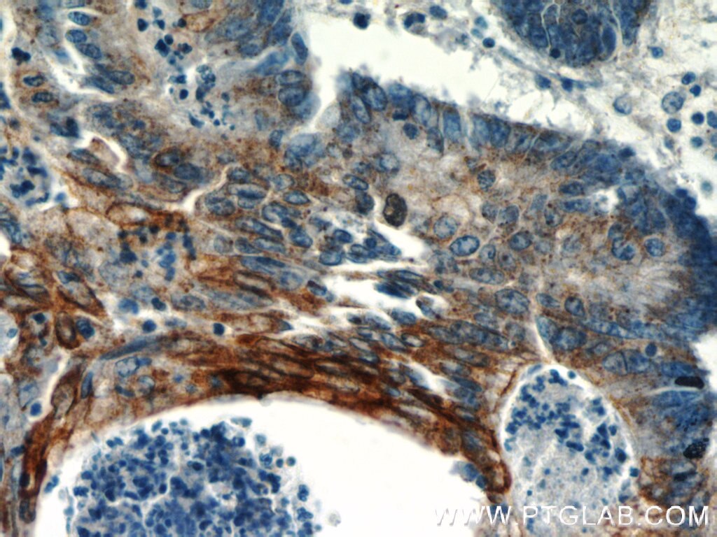 Immunohistochemistry (IHC) staining of human colon cancer tissue using TMEM9B Polyclonal antibody (24331-1-AP)