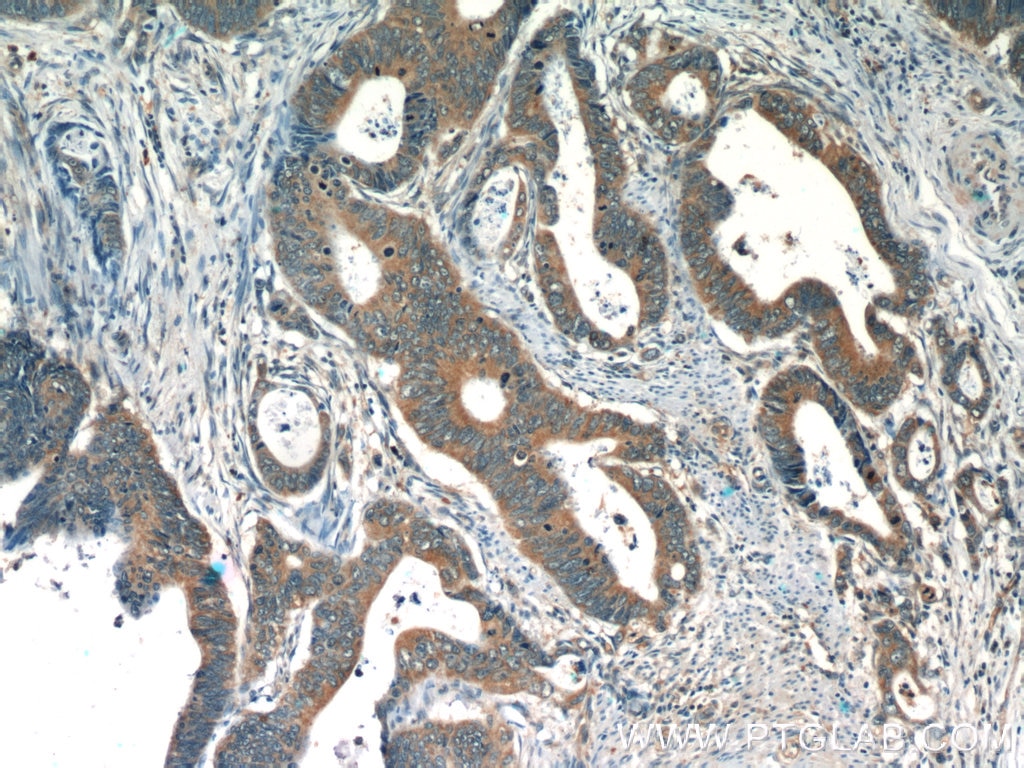 Immunohistochemistry (IHC) staining of human colon cancer tissue using TMF1 Polyclonal antibody (22212-1-AP)