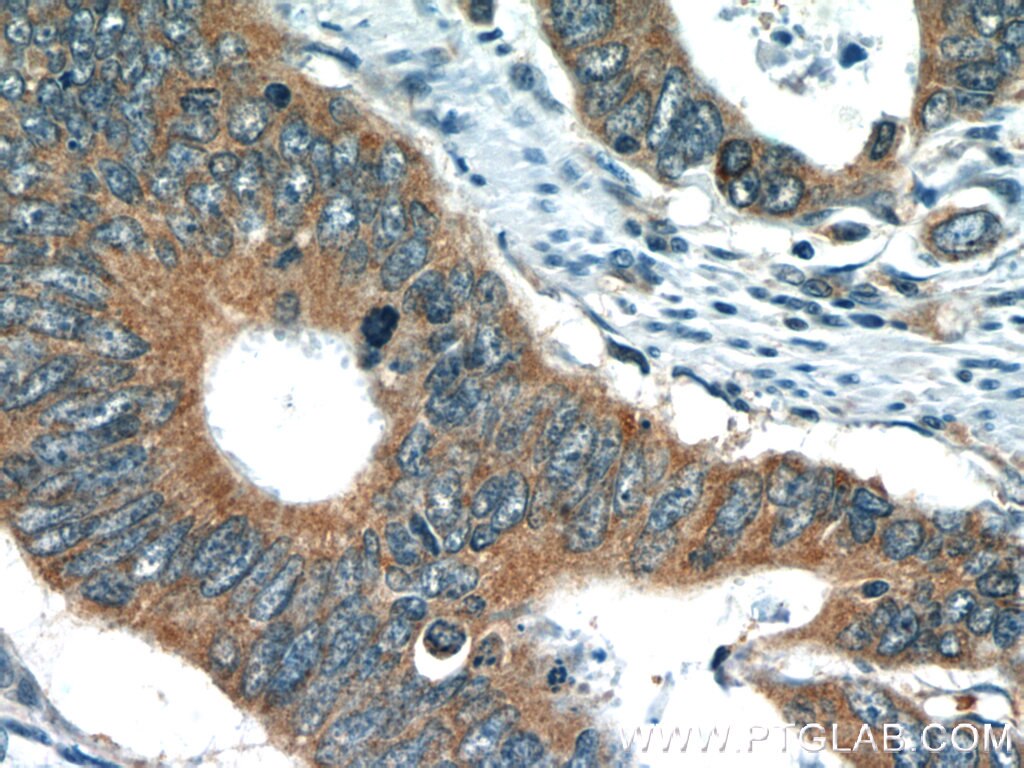 Immunohistochemistry (IHC) staining of human colon cancer tissue using TMF1 Polyclonal antibody (22212-1-AP)