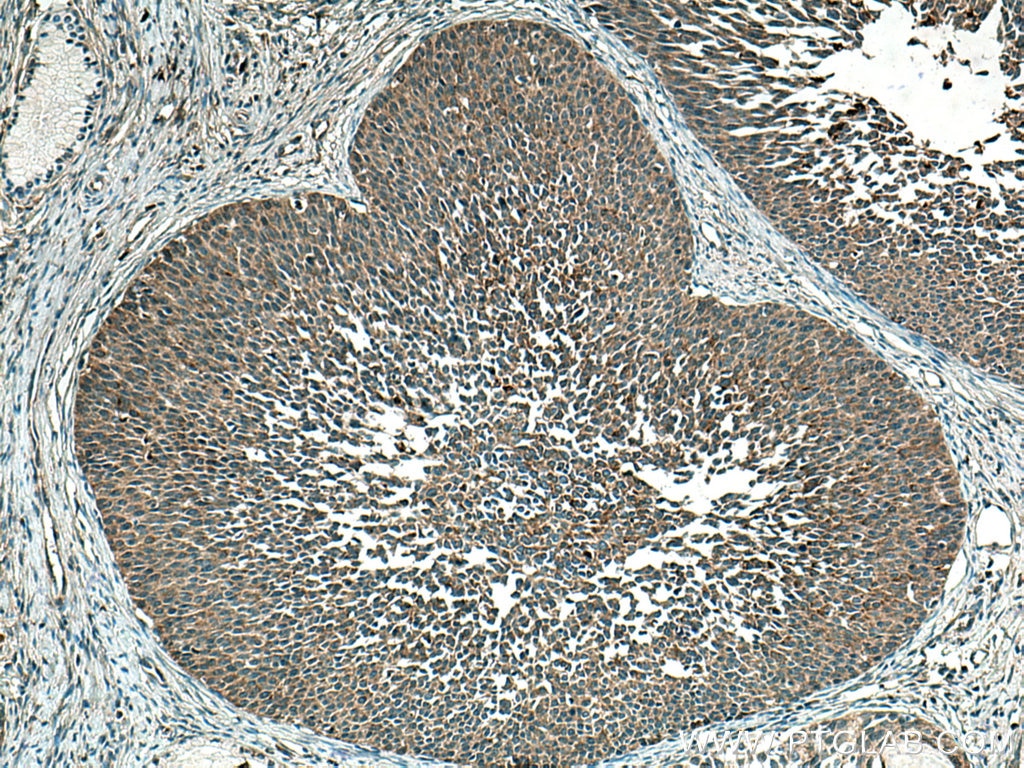 Immunohistochemistry (IHC) staining of human cervical cancer tissue using TMF1-Specific Polyclonal antibody (19728-1-AP)
