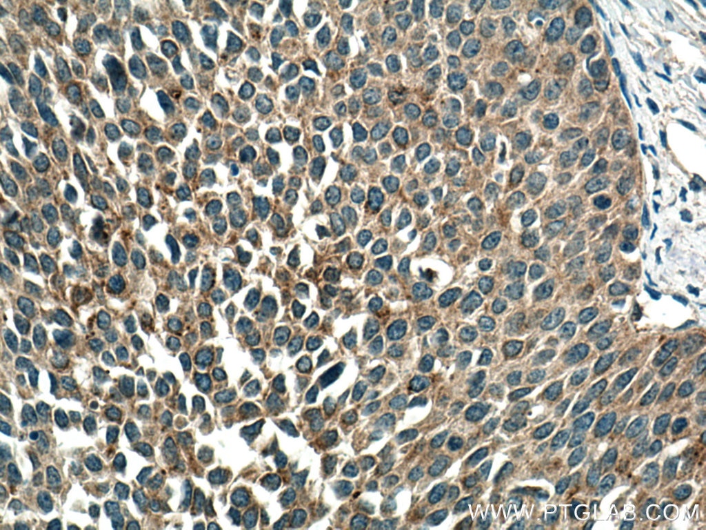 Immunohistochemistry (IHC) staining of human cervical cancer tissue using TMF1-Specific Polyclonal antibody (19728-1-AP)