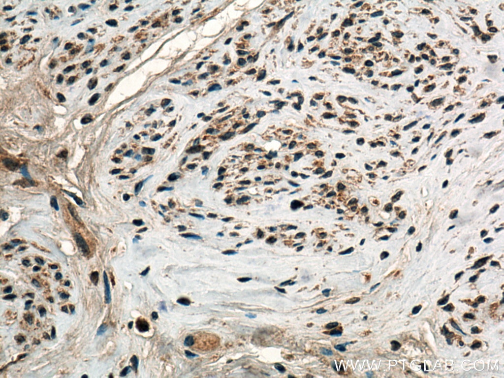 Immunohistochemistry (IHC) staining of human cervical cancer tissue using TMF1-Specific Polyclonal antibody (19728-1-AP)