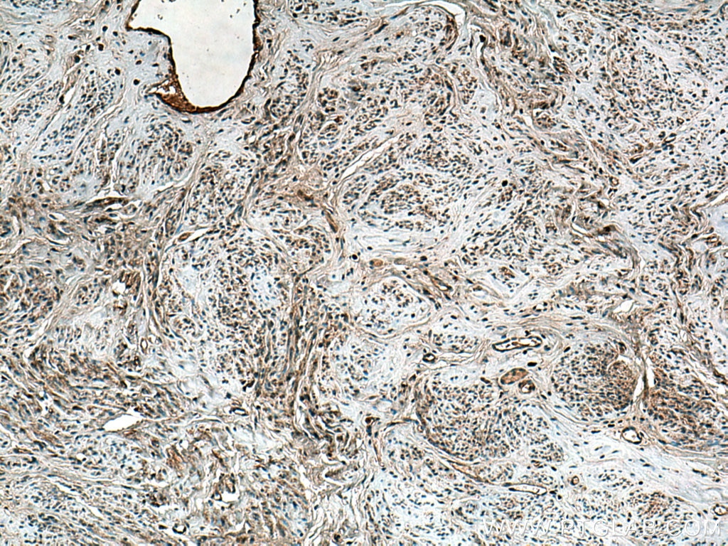 Immunohistochemistry (IHC) staining of human cervical cancer tissue using TMF1-Specific Polyclonal antibody (19728-1-AP)