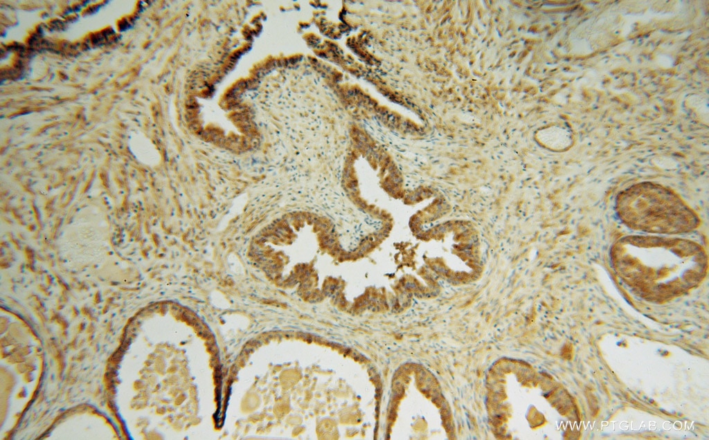 Immunohistochemistry (IHC) staining of human gliomas tissue using TMOD2 Polyclonal antibody (15262-1-AP)