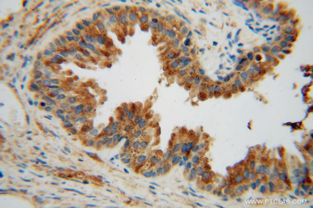 Immunohistochemistry (IHC) staining of human gliomas tissue using TMOD2 Polyclonal antibody (15262-1-AP)