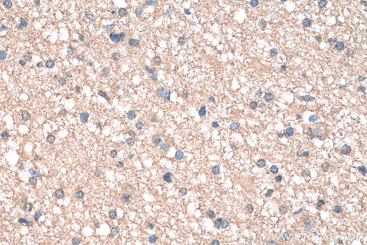 Immunohistochemistry (IHC) staining of human gliomas tissue using TMOD2 Monoclonal antibody (68039-1-Ig)