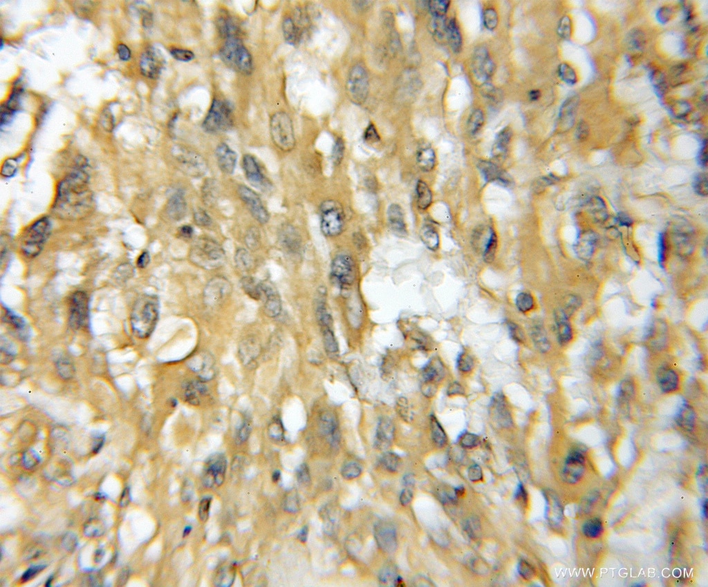 IHC staining of human gliomas using 11753-1-AP