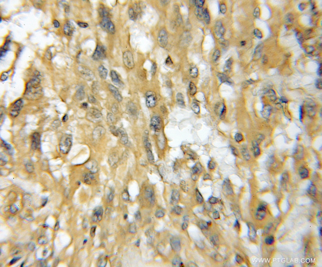 Immunohistochemistry (IHC) staining of human gliomas tissue using TMOD4 Polyclonal antibody (11753-1-AP)