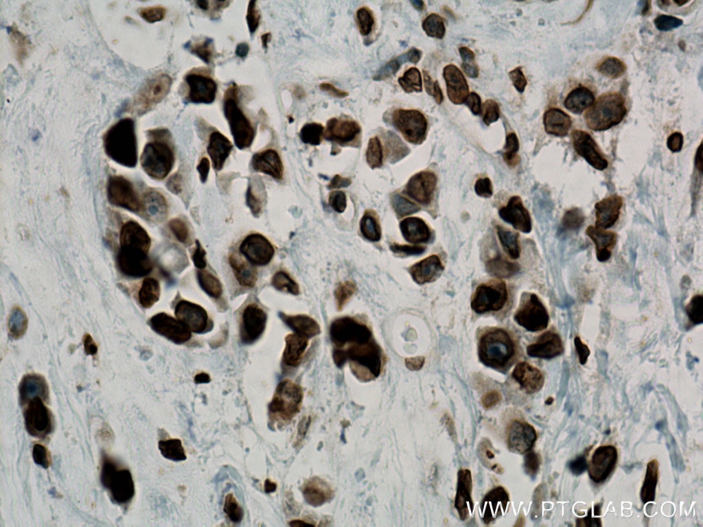 Immunohistochemistry (IHC) staining of human breast cancer tissue using TMPO/LAP2 Polyclonal antibody (14651-1-AP)