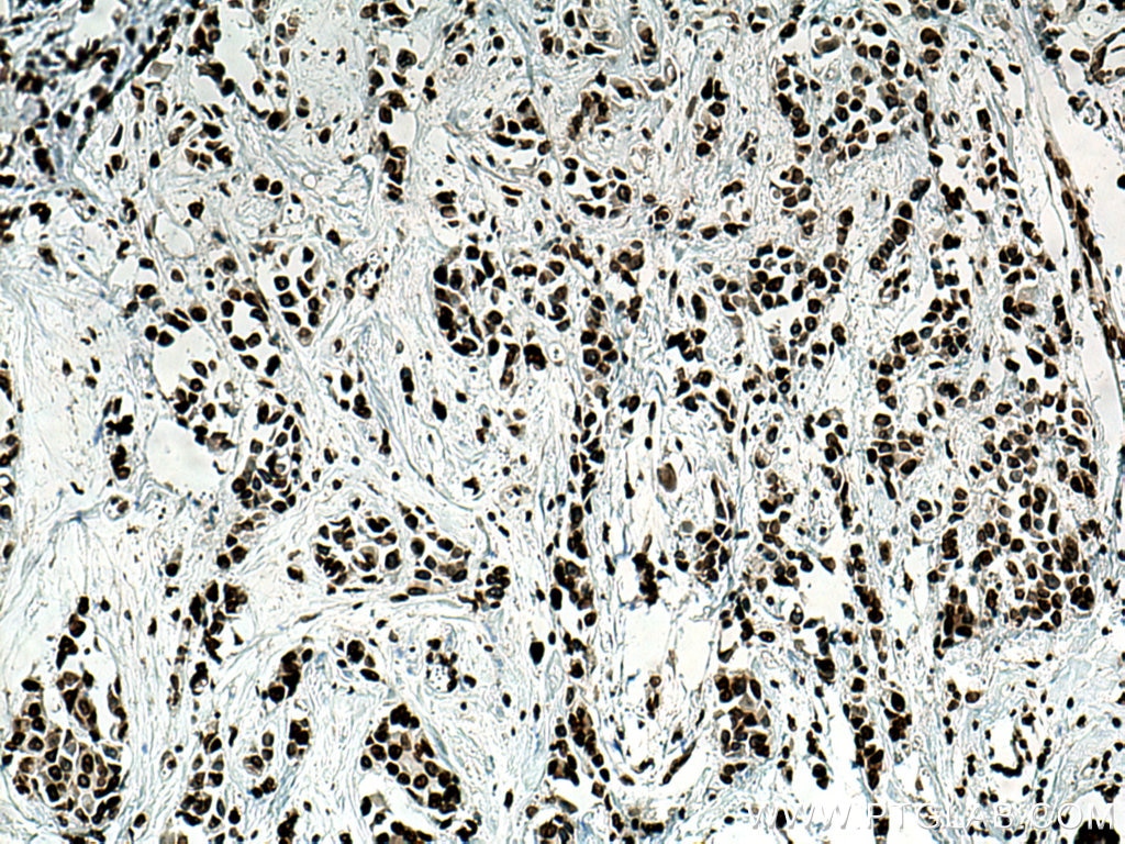 Immunohistochemistry (IHC) staining of human breast cancer tissue using TMPO/LAP2 Polyclonal antibody (14651-1-AP)