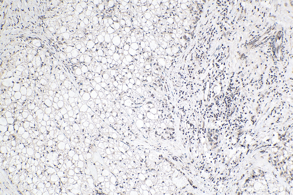 IHC staining of human liver cancer using 14651-1-AP