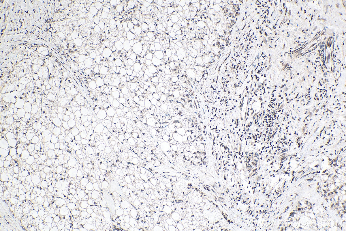 Immunohistochemistry (IHC) staining of human liver cancer tissue using TMPO/LAP2 Polyclonal antibody (14651-1-AP)