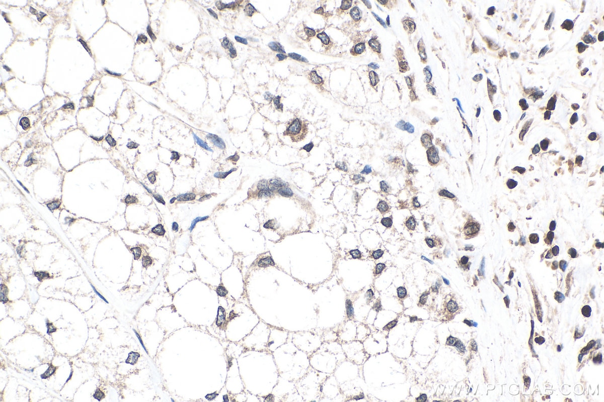 Immunohistochemistry (IHC) staining of human liver cancer tissue using TMPO/LAP2 Polyclonal antibody (14651-1-AP)