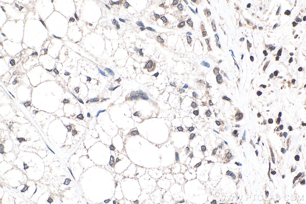 IHC staining of human liver cancer using 14651-1-AP