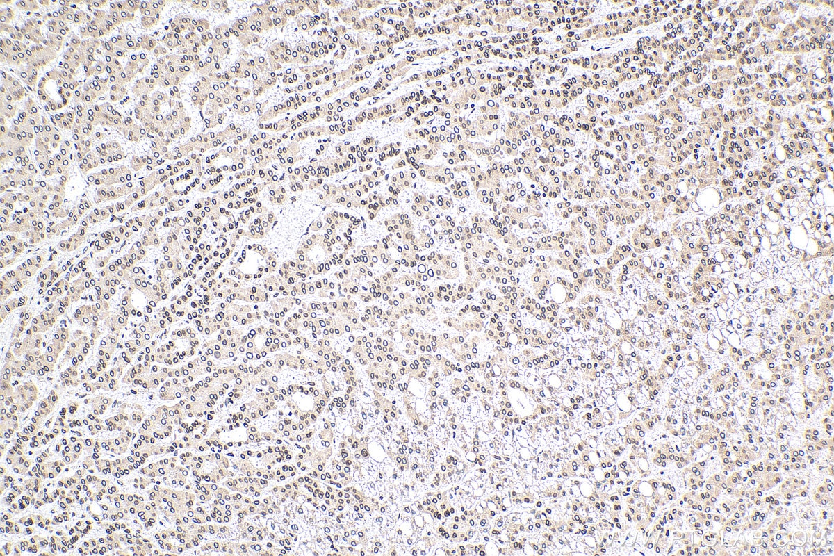 Immunohistochemistry (IHC) staining of human liver cancer tissue using TMPO/LAP2 Monoclonal antibody (67157-1-Ig)