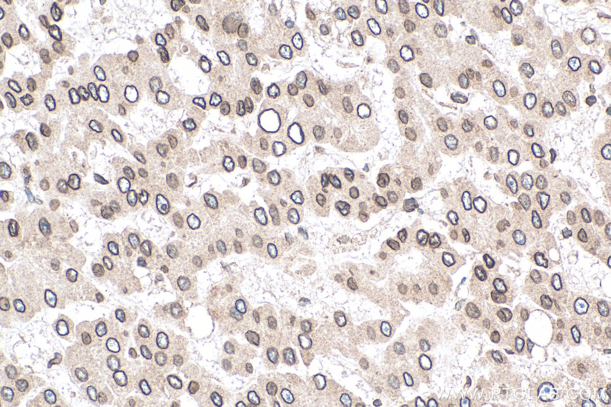 Immunohistochemistry (IHC) staining of human liver cancer tissue using TMPO/LAP2 Monoclonal antibody (67157-1-Ig)