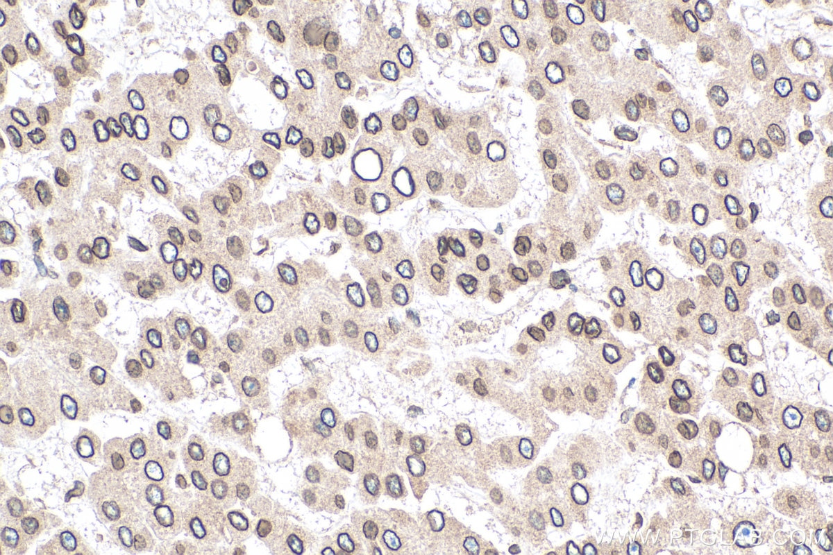 IHC staining of human liver cancer using 67157-1-Ig