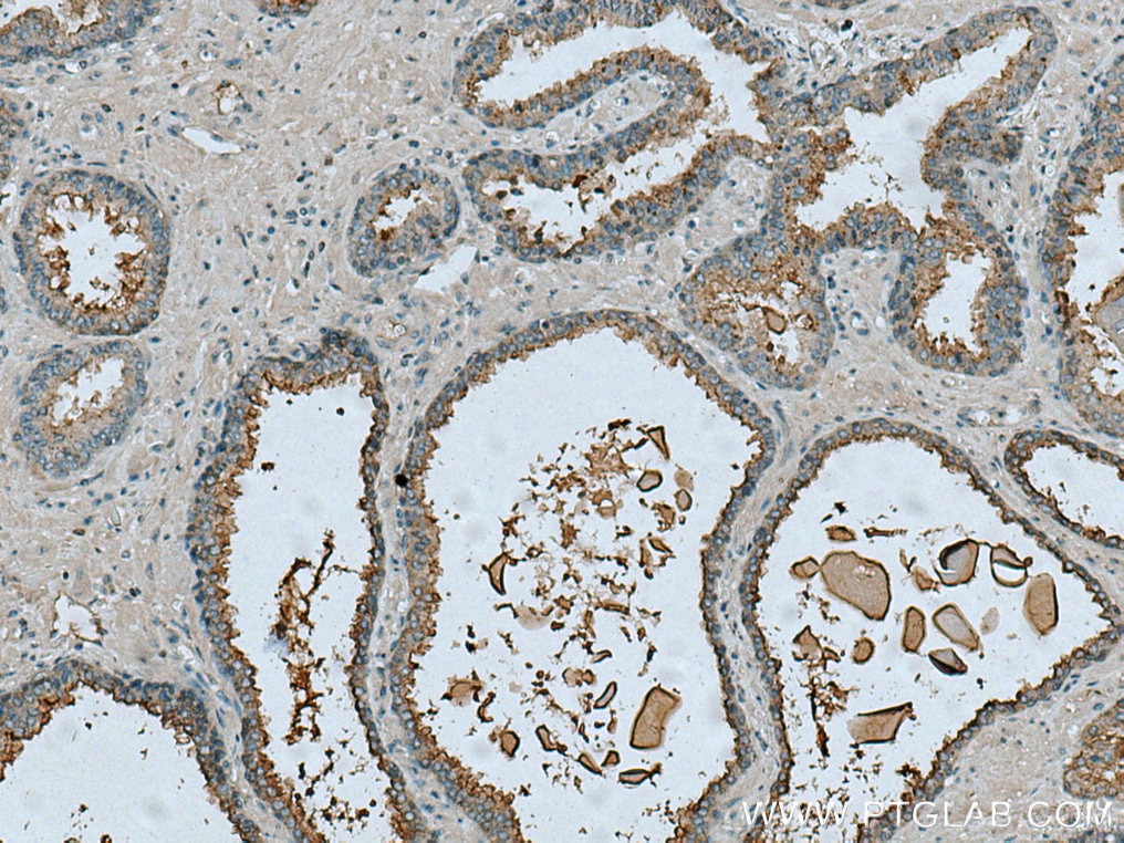 Immunohistochemistry (IHC) staining of human prostate cancer tissue using TMPRSS2 Polyclonal antibody (14437-1-AP)