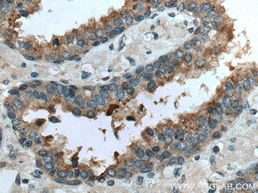 Immunohistochemistry (IHC) staining of human prostate cancer tissue using TMPRSS2 Polyclonal antibody (14437-1-AP)