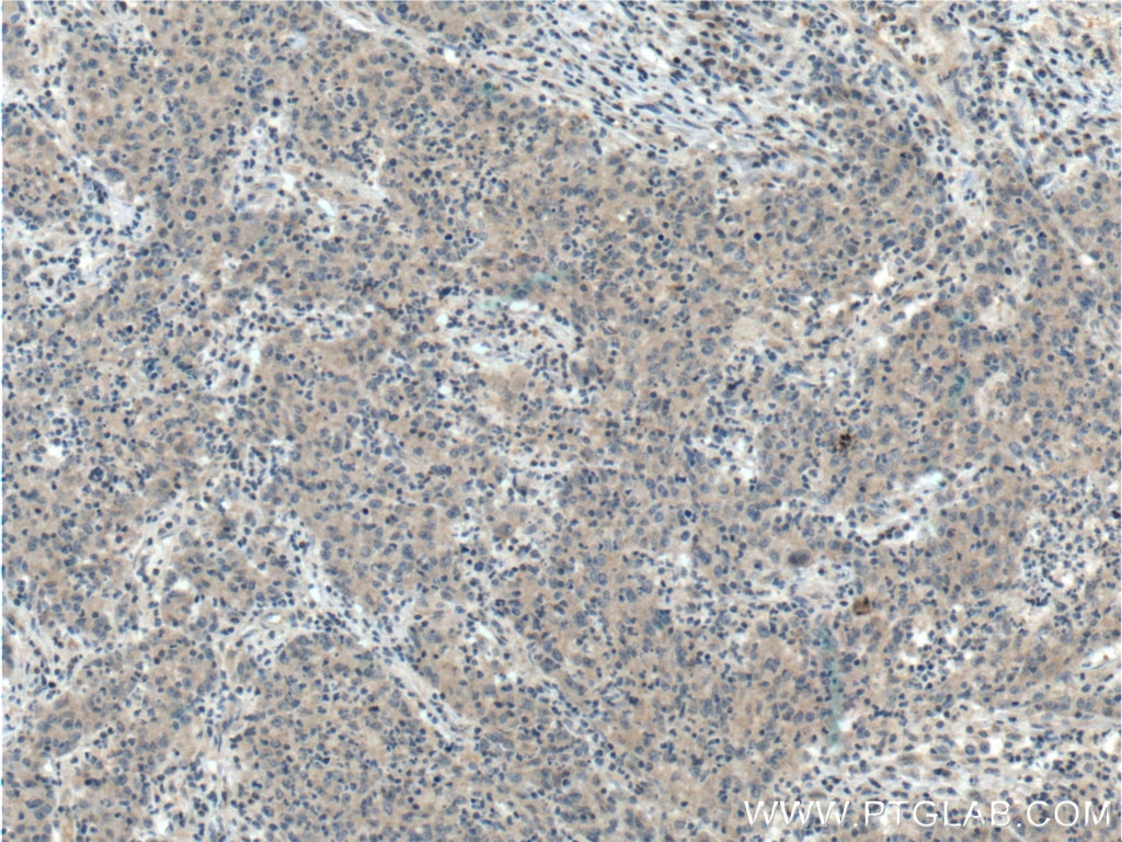 Immunohistochemistry (IHC) staining of human colon cancer tissue using TMPRSS2 Polyclonal antibody (14437-1-AP)