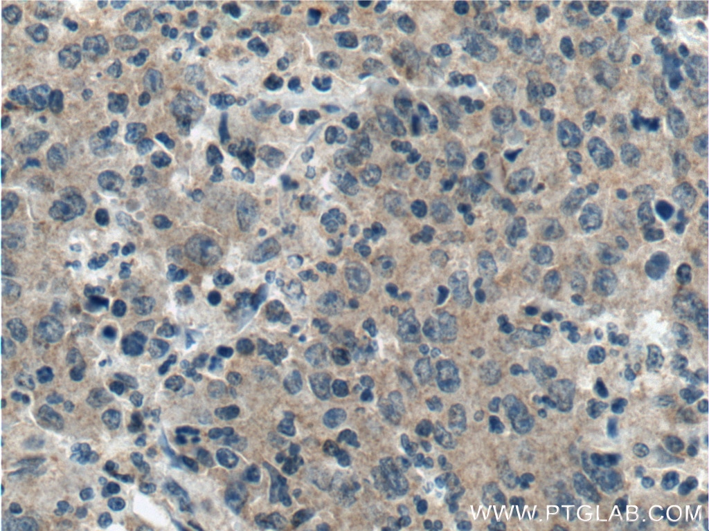 Immunohistochemistry (IHC) staining of human colon cancer tissue using TMPRSS2 Polyclonal antibody (14437-1-AP)
