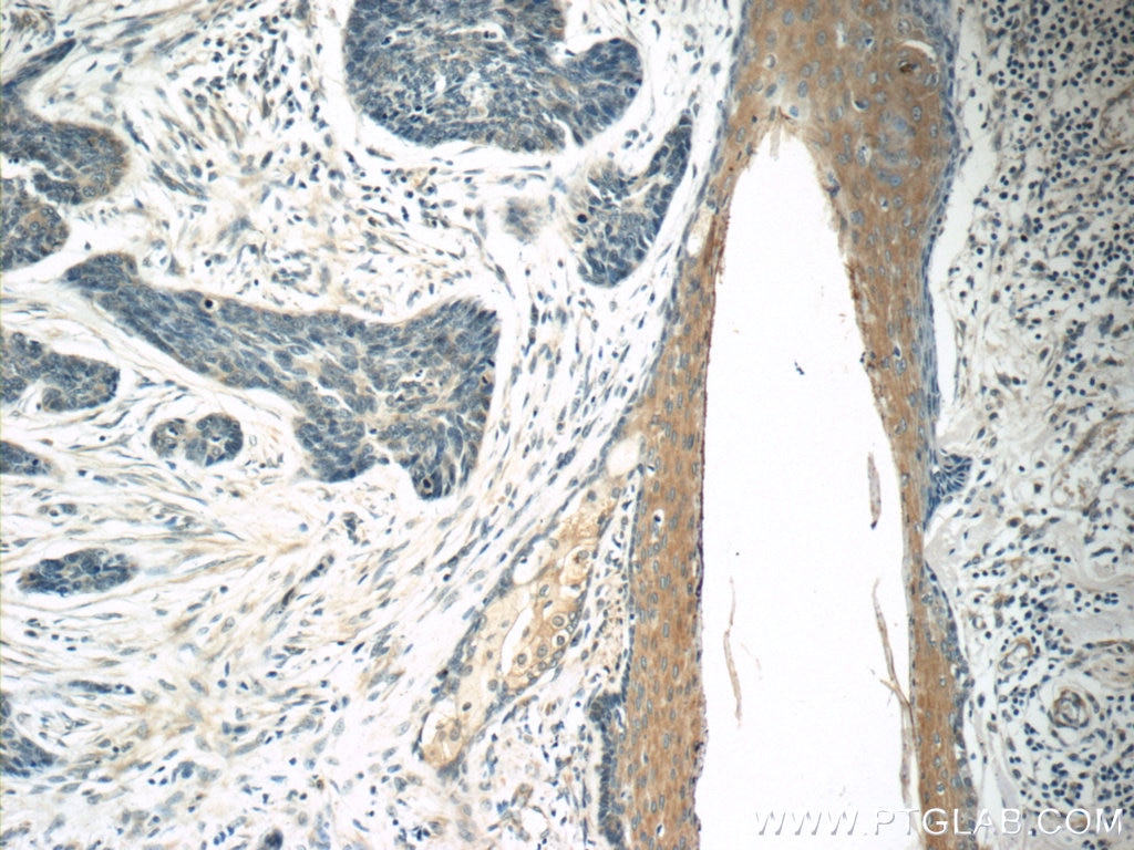 Immunohistochemistry (IHC) staining of human skin cancer tissue using TMPRSS3 Polyclonal antibody (17953-1-AP)