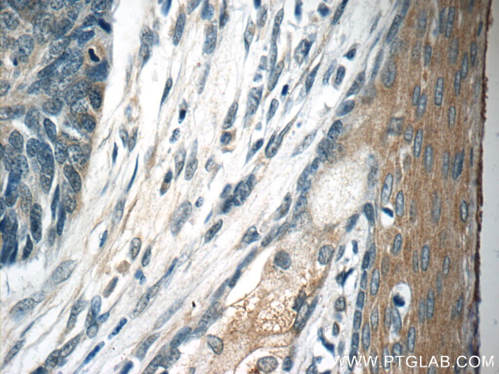 Immunohistochemistry (IHC) staining of human skin cancer tissue using TMPRSS3 Polyclonal antibody (17953-1-AP)